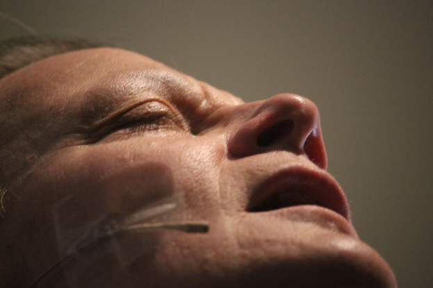 Nahaufnahme eines Frauengesichts während einer Behandlung mit mehreren Nadeln in der Nase, die Augen geschlossen, vor einer neutralen Wand.